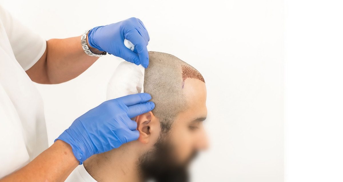 hair transplant