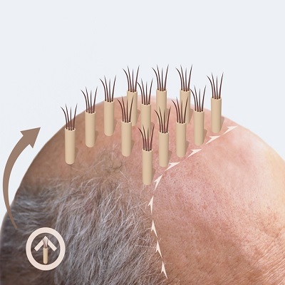 FUT hair transplant in Islamabad Pakistan