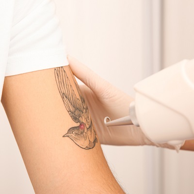 Laser Tattoo Removal  Silhouette Spa  Laser