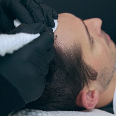 Scalp Micropigmentation in Islamabad