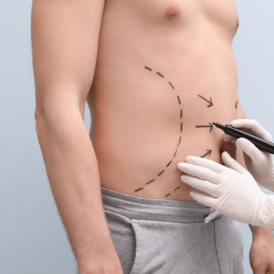 Vaser 4D Liposuction in Islamabad