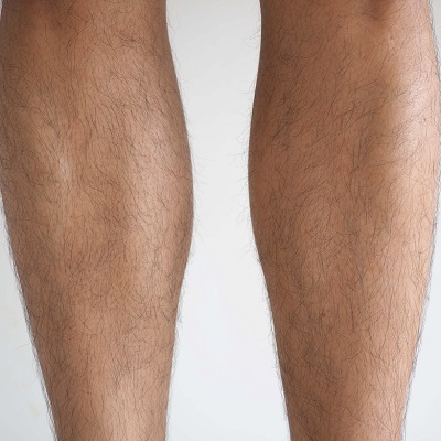 calf reduction in Islamabad