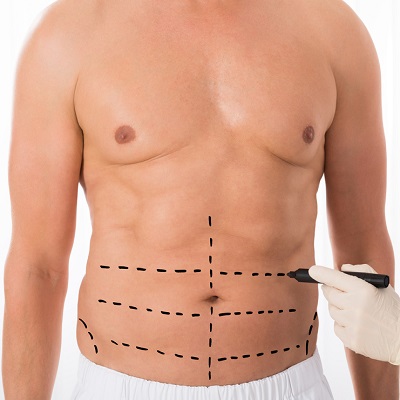 tummy tuck in Islamabad Pakistan