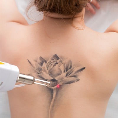 Pico Laser Tattoo Removal in Islamabad |PICO Cost 